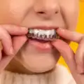 Braces and Aligners Treatment near Rajkot: Guide