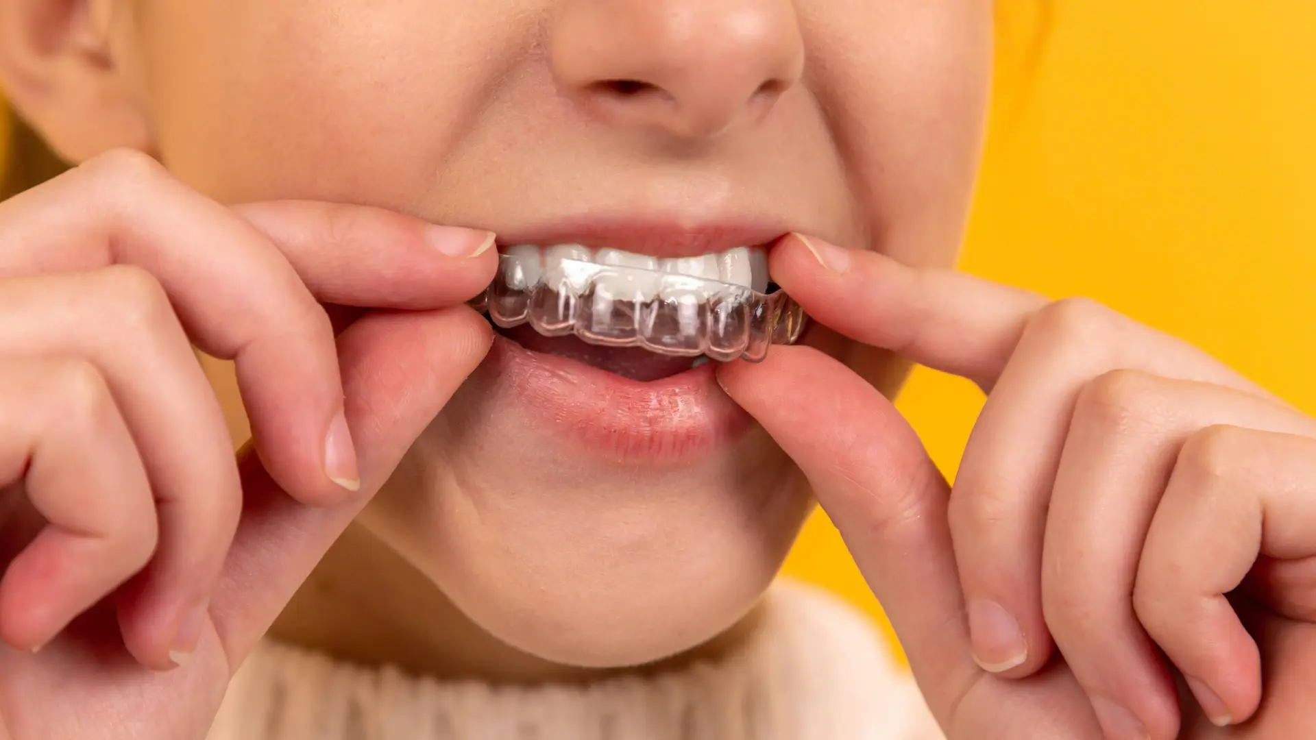 aligners-best-rajkot