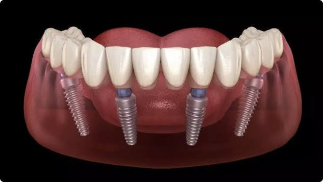 dental-implants-rajkot